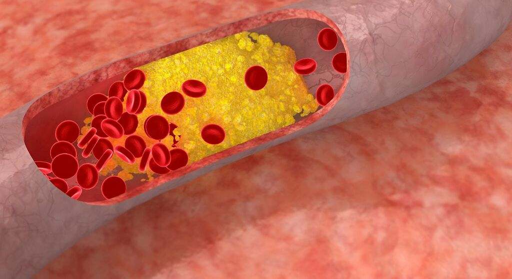 COMO BAJAR NIVELES ALTOS DE COLESTEROL Y TRIGLICERIDOS – ANTIVIRAL
