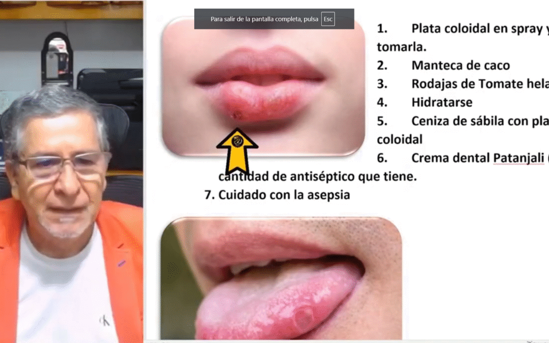 AFTAS BUCALES Ó HERPES FEBRIL – Tratamiento Natural
