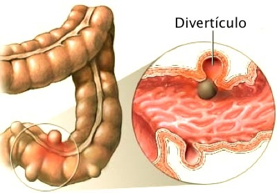 Divertículos – Patrones alimentarios – Salud Natural