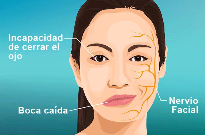 PARÁLISIS FACIAL_ PATRONES ALIMENTARIOS Y TERAPIAS NATURALES