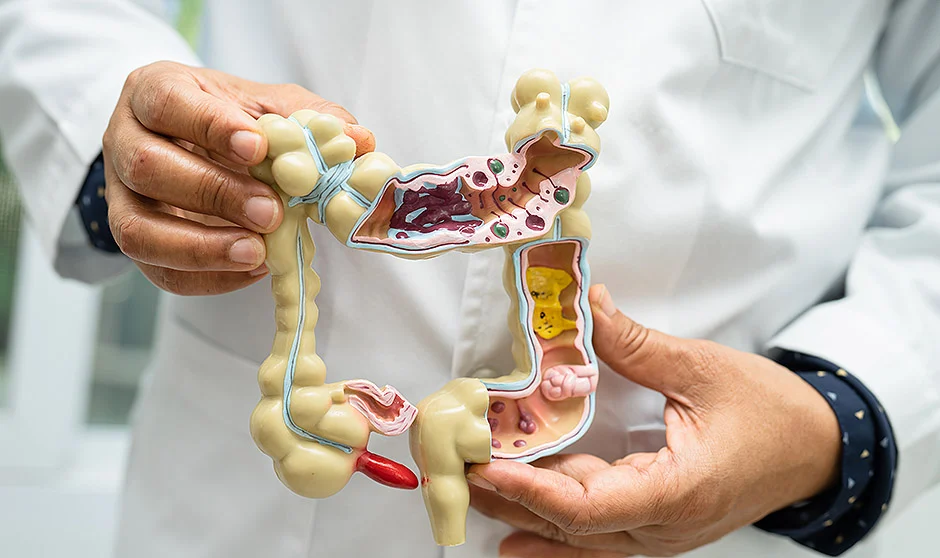 DIVERTICULITIS