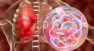 TUBERCULOSIS – SOLUCION NATURAL Y PATRONES ALIMENTARIOS