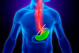 ACIDEZ ESTOMACAL – REFLUJO GASTRICO