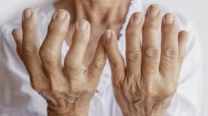 ARTRITIS REUMATOIDEA – OSTEOARTRITIS – FIBROMIALGIA