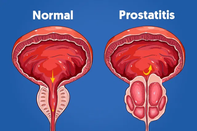 PROSTATITIS – SALUD NATURAL – REGULACIÓN ALIMENTARIA