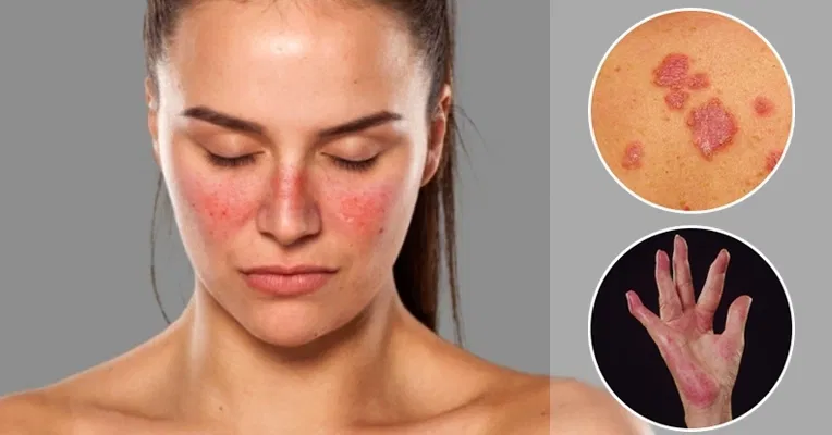 LUPUS – INFERTILIDAD – TEMAS VARIOS DE ALIMENTACION Y SALUD NATURAL