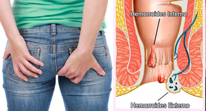 HEMORROIDES – DIVERTICULOS – COLON OBSTRUIDO – ESTREÑIMIENTO