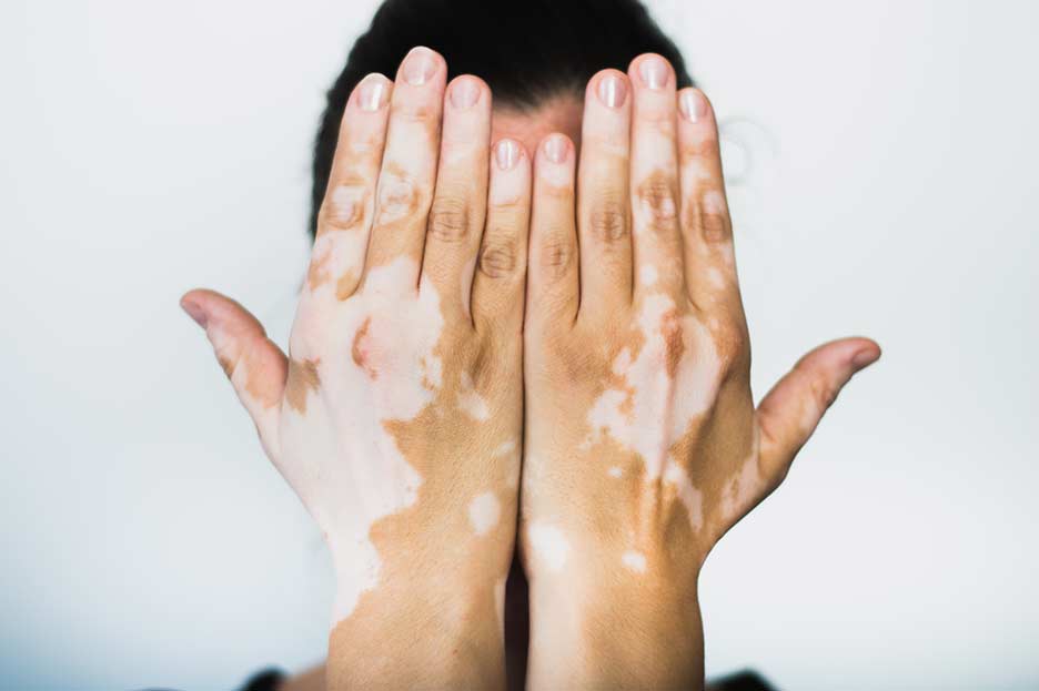 VITILIGO – PATRONES ALIMENTARIOS Y TERAPIAS NATURALES